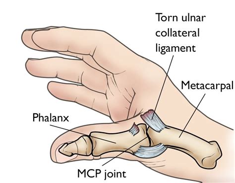 Collateral Ligament Injury — Miami Bone And Joint Institute Premier