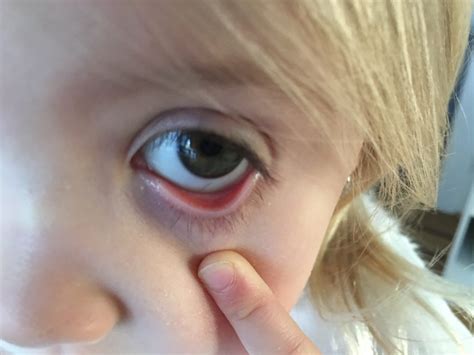 What Can Your Childs Lower Eyelids Tell You About Low Iron Levels