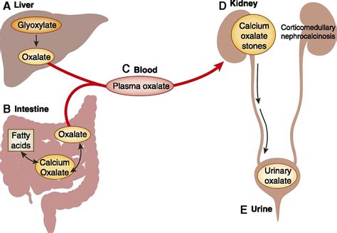 Pathophysiology And Treatment Of Enteric Hyperoxaluria Clinical