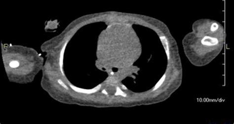 Complete Bronchial Obstruction By Granuloma In A Paediatric Patient