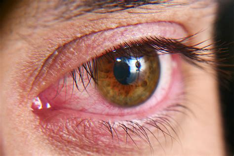 Quick Guide To Dry Eyes Syndrome To The Time