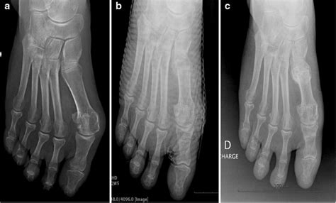 Percutaneous Metatarsal And Phalangeal Osteotomies A Preoperative Download Scientific Diagram