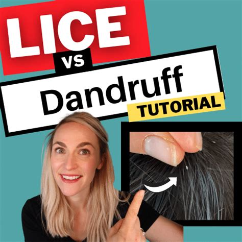 Lice Vs Dandruff Video Tutorial My Lice Advice