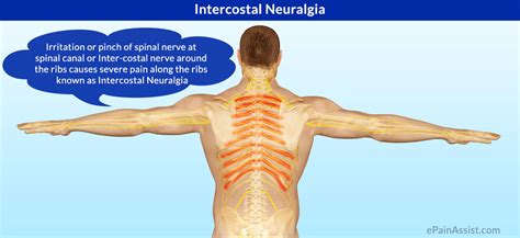 It might happen after an apparent injury or without description. What is Intercostal Neuralgia|Symptoms|Causes|Treatment ...