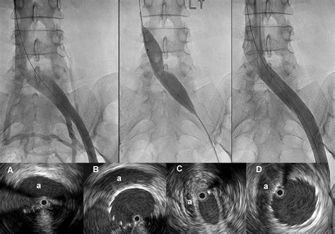 Stenting Of The Venous Outflow In Chronic Venous Disease Long Term