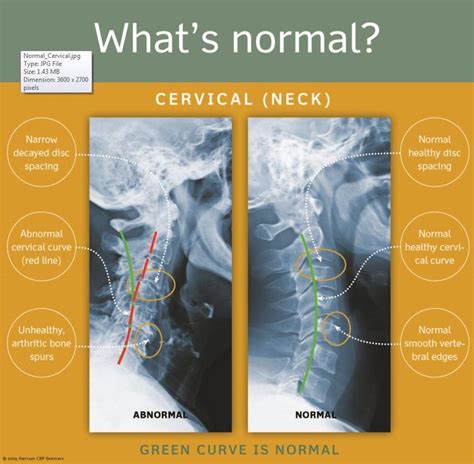 1 Normalcervical Chiropractic Cervical Scoliosis Exercises