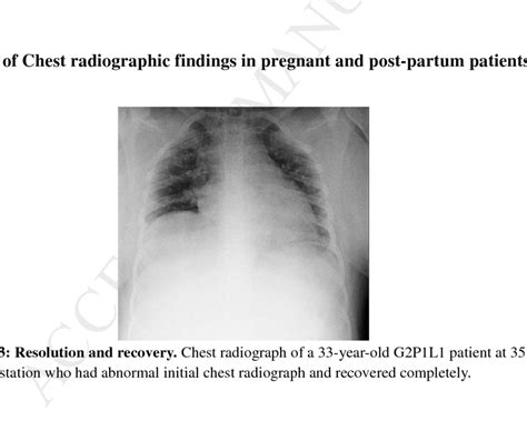 Worsening Of Chest Radiographic Findings A D Serial Chest
