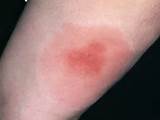 What Is In A Wasp Sting Images