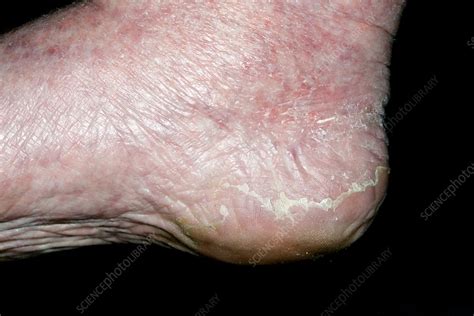 Exfoliative Dermatitis On The Foot Stock Image C0213317 Science