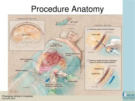 Ppt Paracentesis Powerpoint Presentation Free Download Id6590134