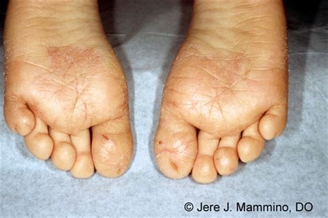 Juvenile Plantar Dermatosis American Osteopathic College Of