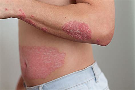 Psoriasis Symptoms Causes Types And Treatments
