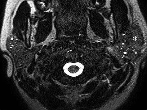 12 Year Old Child With Juvenile Recurrent Parotitis Magnetic Resonance
