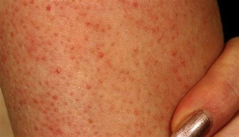 Keratosis Pilaris Pictures 2 Dorothee Padraig South West Skin Health Care