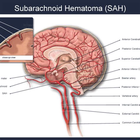 Subarachnoid Hematoma Sah Trialexhibits Inc