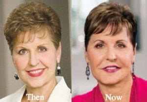 Joyce Meyer Plastic Surgery Chin Improvement Lip Augmentation Facelift