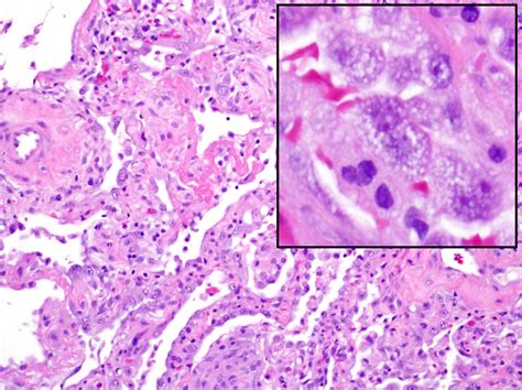 Ali W Hyaline Membranes Patterns Of Pulmonary Pathology