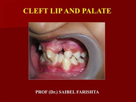 Cleft Lip And Palate Ppt