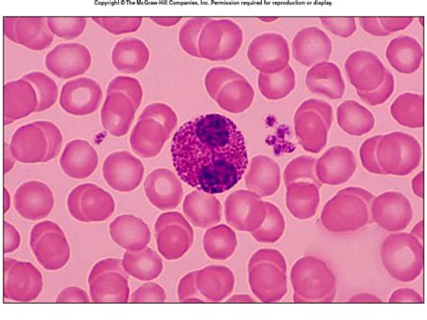 18 Best Images About Eosinophils On Pinterest Allergies
