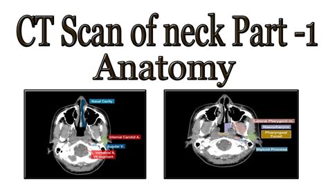 Ct Scan Of Neck Anatomy Part 1 Youtube