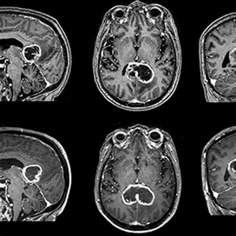 Normal And Abnormal Mri Brain Scans