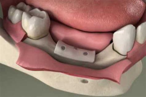 Enxertoosseoembloco50kb Clínica Odontológica De Implante Dentário
