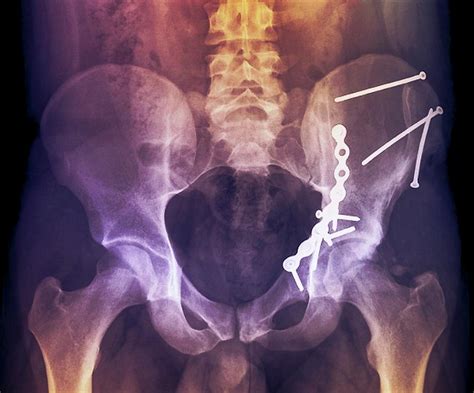 Pinned Hip Fractures Photograph By Zephyrscience Photo Library