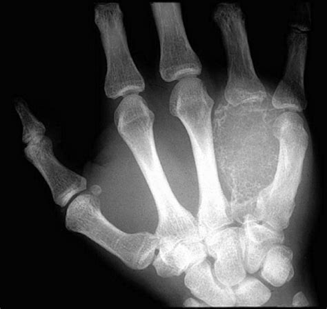 Aneurysmal Bone Cyst X Ray