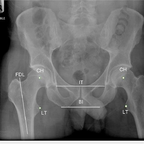 An Anteroposterior Ap Radiograph Of The Pelvis Shows The Different