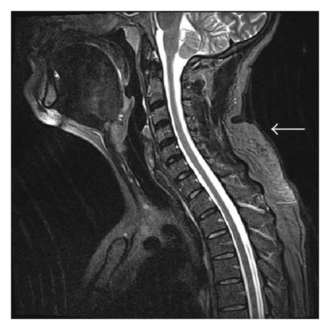 Mri Of The Neck Demonstrates A Subcutaneous Mass White Arrows In The