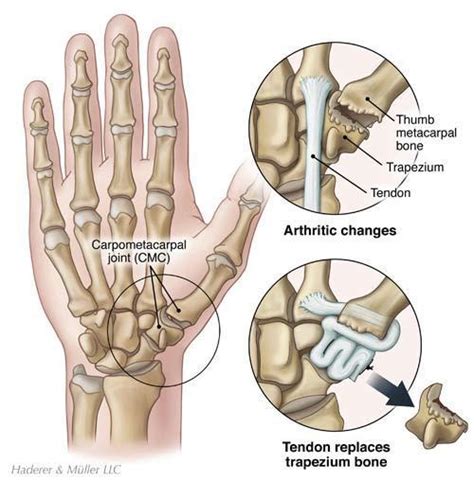 Thumb Cmc Basal Joint Arthroplasty Thumb Joint Reconstruction