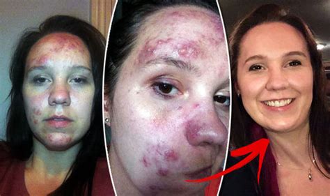 Rosacea Treatment Caper Cream Cured Womans Painful Skin Condition