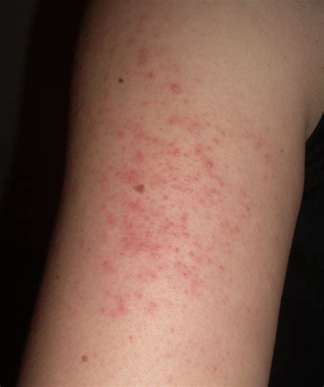 How To Naturally Treat A Leg Skin Rash Bellatory