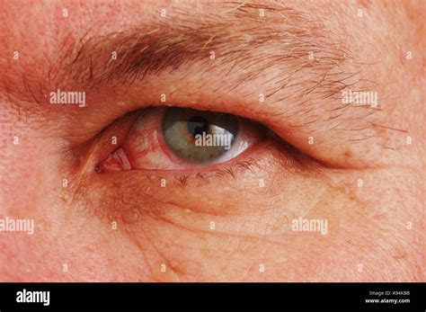 Blood In Sclera Hi Res Stock Photography And Images Alamy