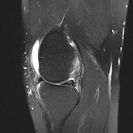 Vertical Meniscal Tear Radiology Reference Article Radiopaedia Org