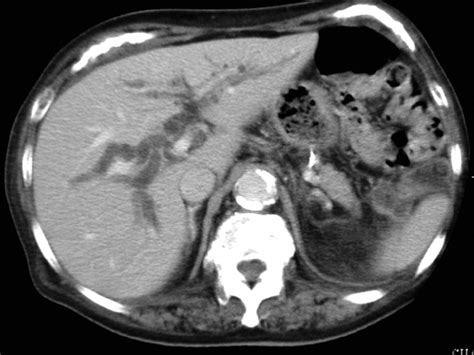 Contrast Enhanced Abdominal Computed Tomog‐ Raphy Ct Image Obtained 5