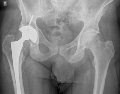 Urinary Markers Suggests Bone Problems After Hip