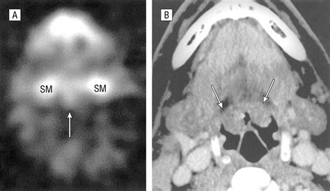 Occult Primary Tumors Of The Head And Neck Accuracy Of Thallium 201