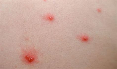 Coronavirus Symptoms Update Skin Conditions Linked To The Covid 19
