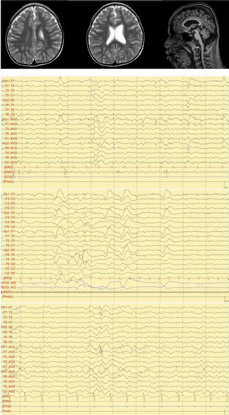 Magnetic Resonance Imaging Mri And Electroencephalography Eeg Download Scientific Diagram