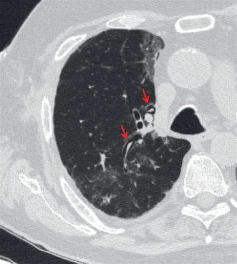 Initial Axial Chest Ct Two Weeks Prior Shows Interstitial Emphysema