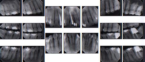 X Rays Hornell Ny Gentle Dentist
