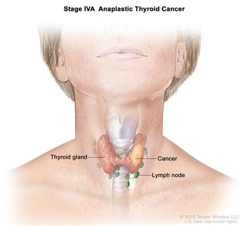 Thyroid Cancer Treatment Adult Vanderbilt Ingram Cancer Center