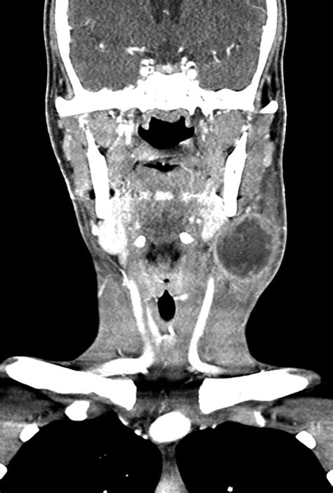 Hiv Lymphadenopathy Differential Diagnosis And Important Imaging