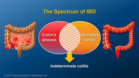 As More Is Learned About The Genetics Of Crohns Disease And Uc It Is