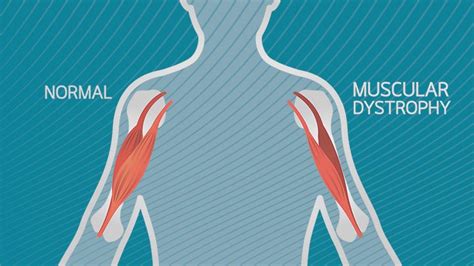 Massage For Muscular Dystrophies Santa Barbara Deep Tissue Riktr