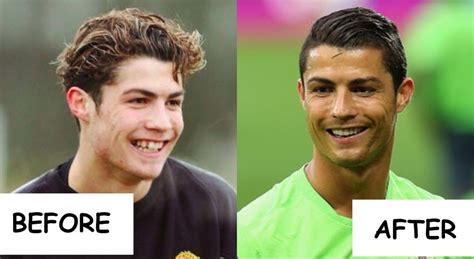 Cristiano Ronaldo Before Surgery Cristiano Ronaldo S Before And After Plastic Surgery He