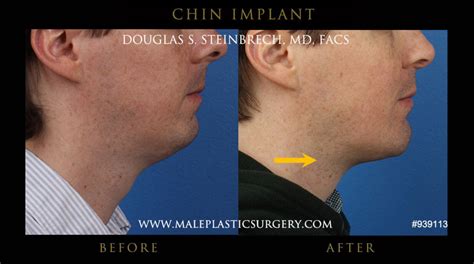 Chin Implants Gallery Male Plastic Surgery