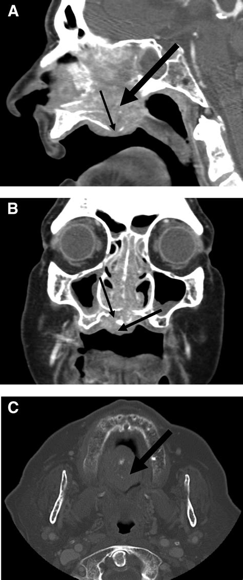 Sagittal A Coronal B And Transverse C Sections Of Maxillofacial