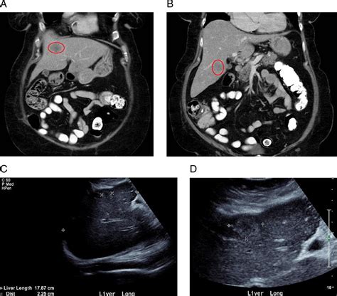 Maybe you would like to learn more about one of these? Metastatic small-cell lung cancer presenting as fulminant ...